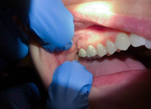 Best Emergency Treatment for Oral Infections in Mill Hall, PA